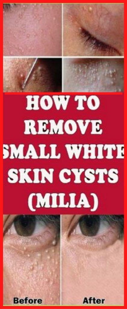 Milia is a group of white, small, solid, keratin filled cysts.

Those cysts are forming under the skin when the keratin remains stuck below its surface. Keratin actually is a very strong protein that is found in the tissues of the skin cells, nails and hair. These cysts are large or strange looking , similar to pimples, but it’s easy to identify them.

It is very important to mention that Milia could occur at persons of all ages, but most often it occurs in newborns. Besides the fact that they disappear within a few weeks, the doctors say that nearly half of the newborn babies have signs of miles. Typically they are large around 1 – 2 mm and they usually occur in areas around the eyes, nose and cheeks. Still, in some cases they could occur on some other body parts.

If you want to remove them we are suggesting you a few alternative methods.

Subcutaneous prick
This is the most commonly used method for dealing with milia. You are going to need thin and sterilized needle under the skin to inject every cyst and inject the liquid.

Peeling
In case Milia are persistent, there are some other options for removing, like chemical peeling or Microdermabrasion.

Retinoids
Local application of a very small amount of cream with retinoids on the cystic bumps is a very easy yet effective way to remove Milia