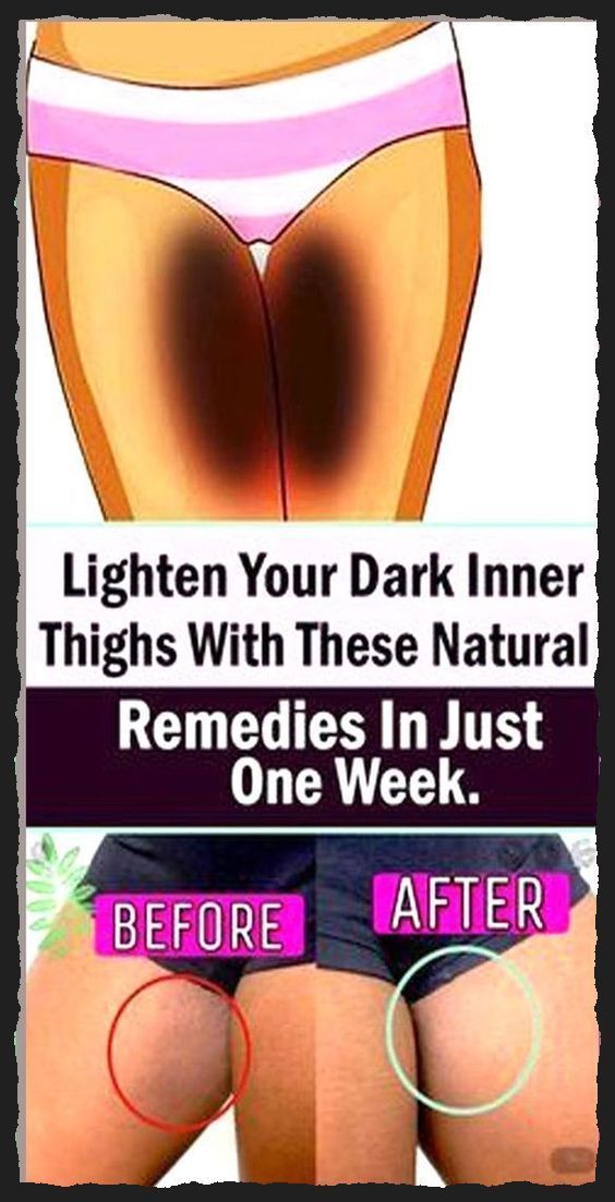 4 natural home remedies to lighten your dark inner thighs